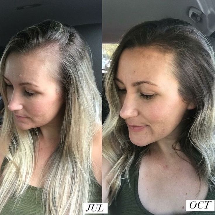 Hair Growth Accelerator - with Lustriva®